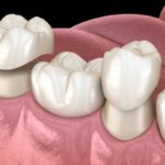 CEREC crowns, traditional crowns, dental crowns, restorative dentistry, dental care, Dental Smiles Family & Cosmetic Dentistry, Austin TX, dental technology, tooth restoration, dental options