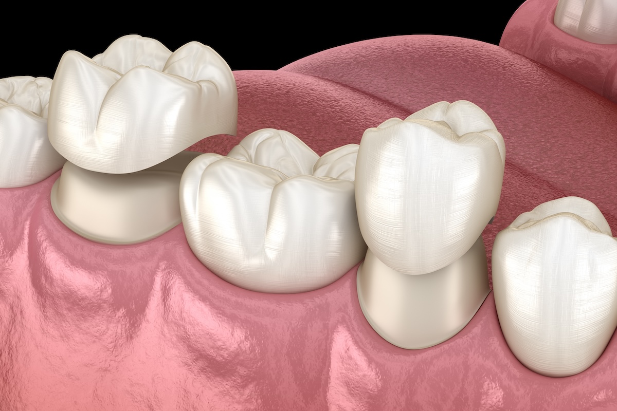 digital image of porcelain crowns