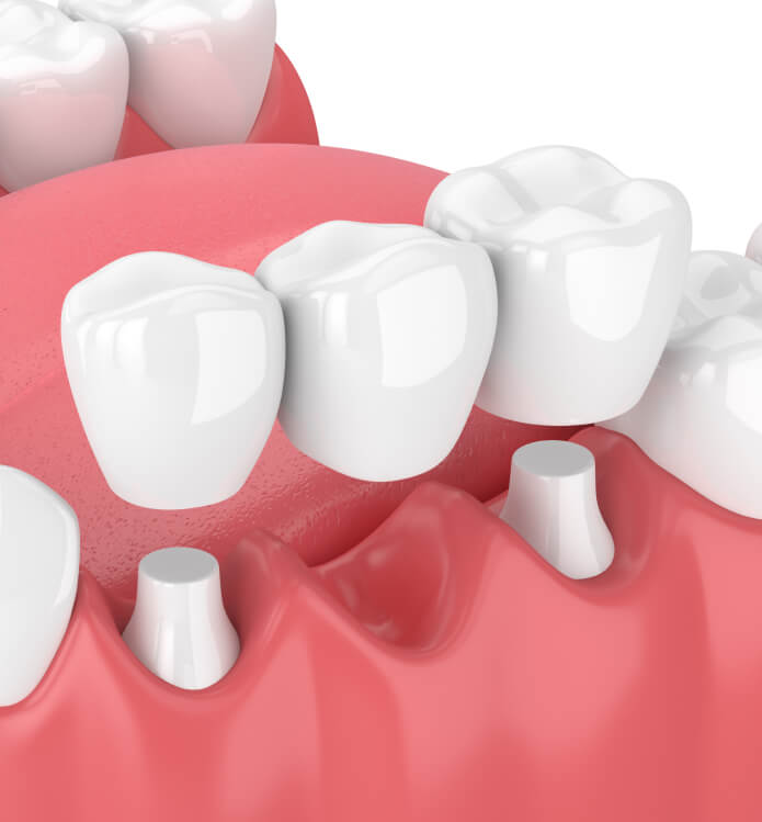 illustration of a dental bridge