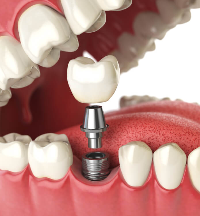 illustation of a dental implant